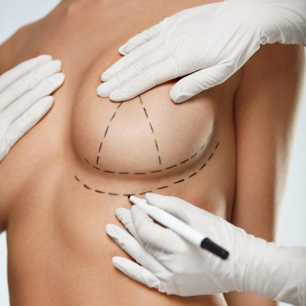 Breast Lift (Mastopexy) Scars & Incisions