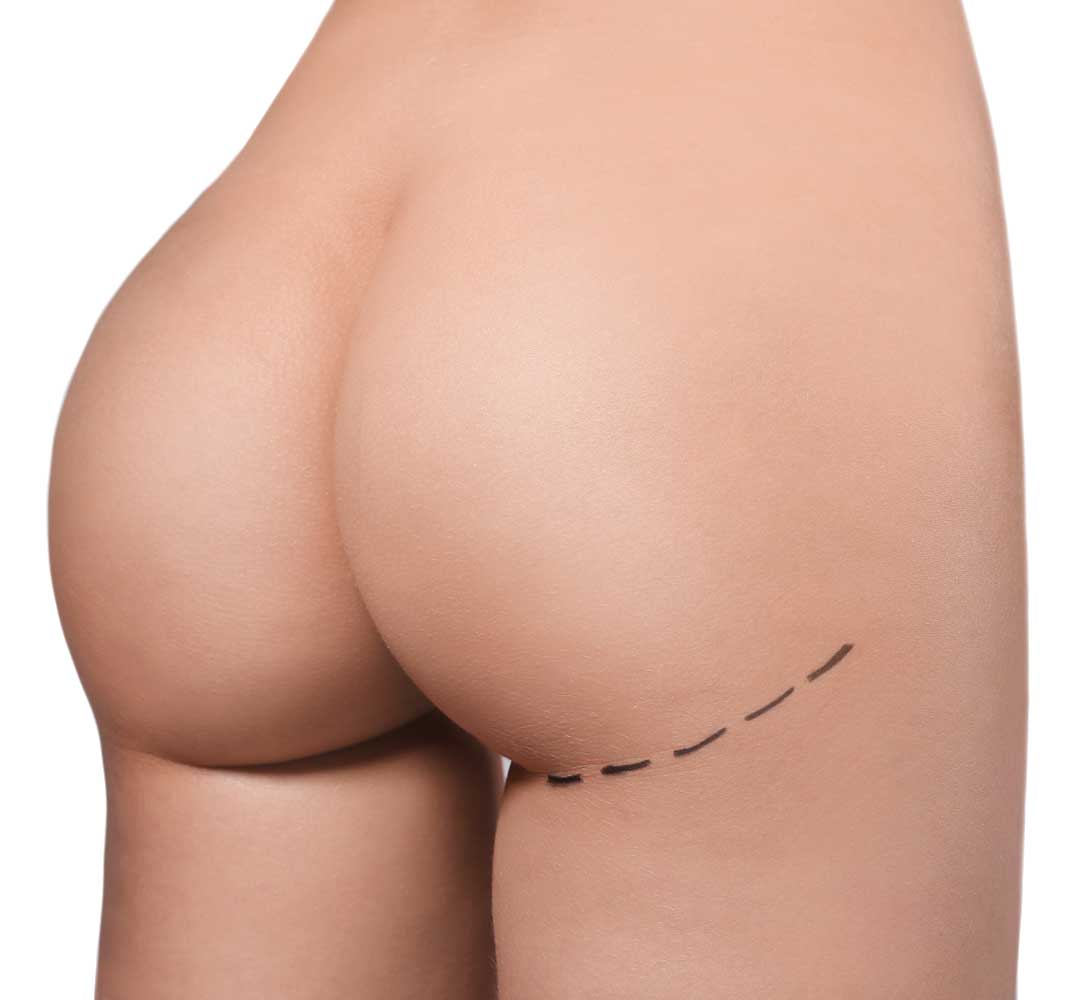 Buttock Lift  North Atlanta Plastic Surgery Group