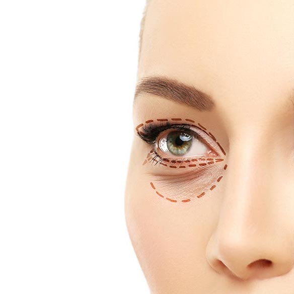 Lower eyelid clearance blepharoplasty