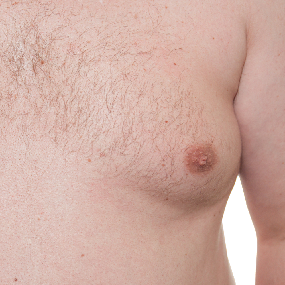 Gynecomastia in Jacksonville, FL - PVPS