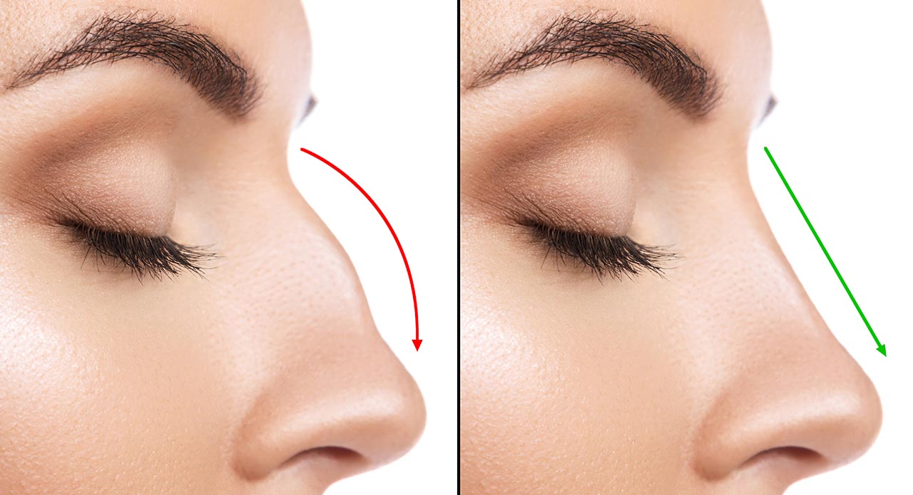 rhinoplasty before and after atlanta