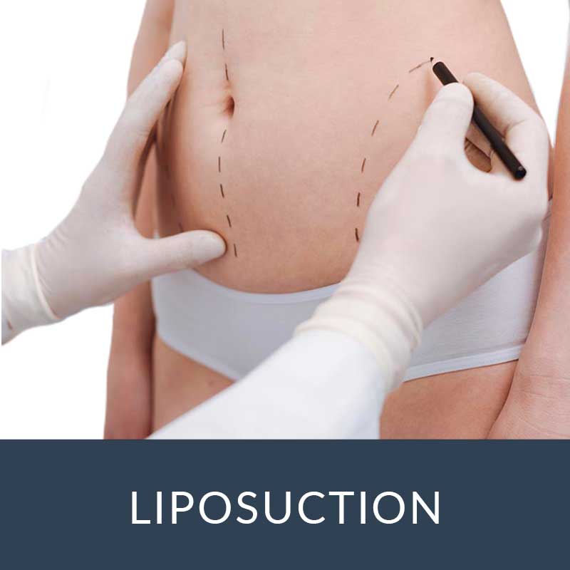 liposuction atlanta